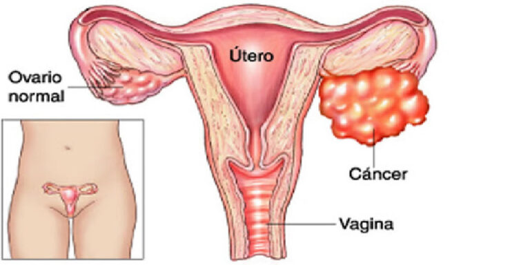 Conoce un enemigo silencioso y mortal para las mujeres